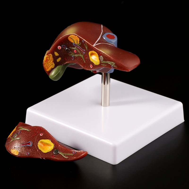 Medical Lab Technology - Human Lever Pathologische Anatomisch Model Anatomie